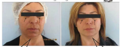 traitement du relâchement de l'ovale du visage